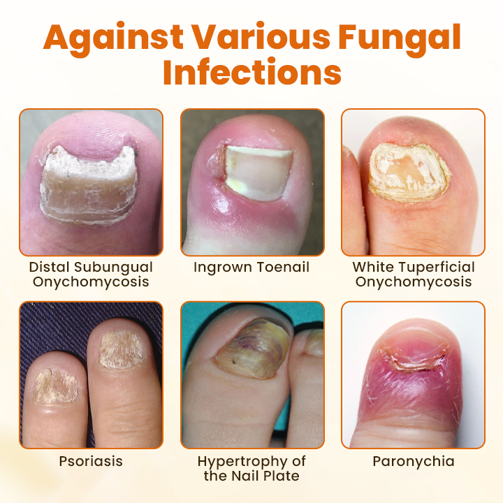 ODALIT Advanced Nail Repair Spray — Bee Venom Powered Nail Fungus Treatment | 60% OFF Today
