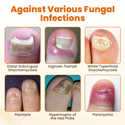 ODALIT Advanced Nail Repair Spray — Bee Venom Powered Nail Fungus Treatment | 60% OFF Today