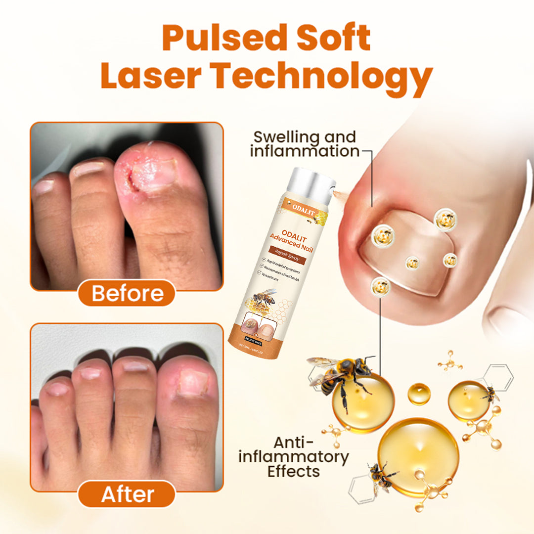 ODALIT Advanced Nail Repair Spray — Bee Venom Powered Nail Fungus Treatment | 60% OFF Today