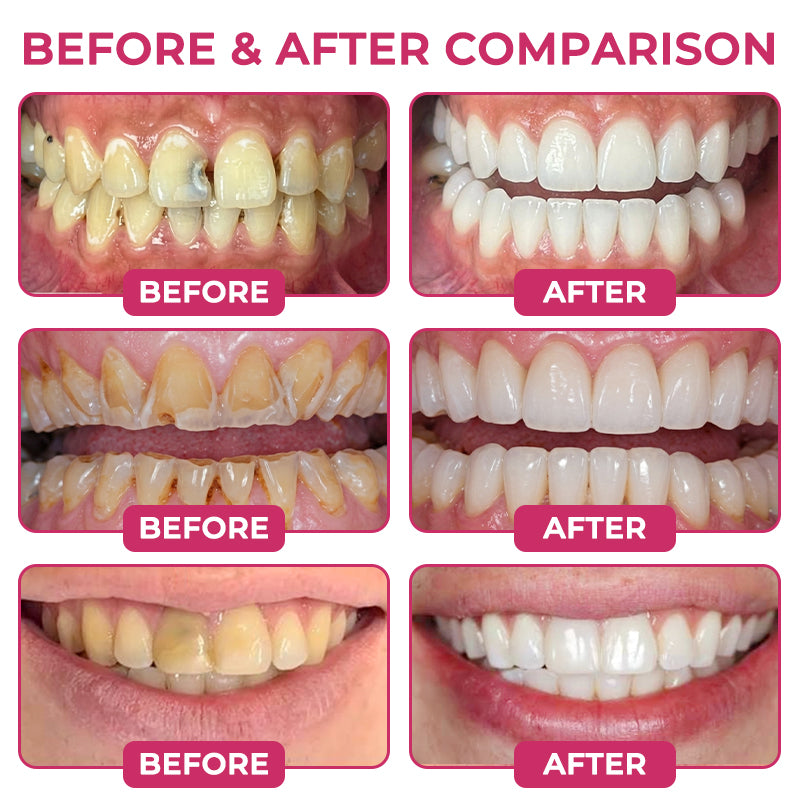🦷 LXNDS DenPerm Cavity-Repair Natural Enamel Filling Gel