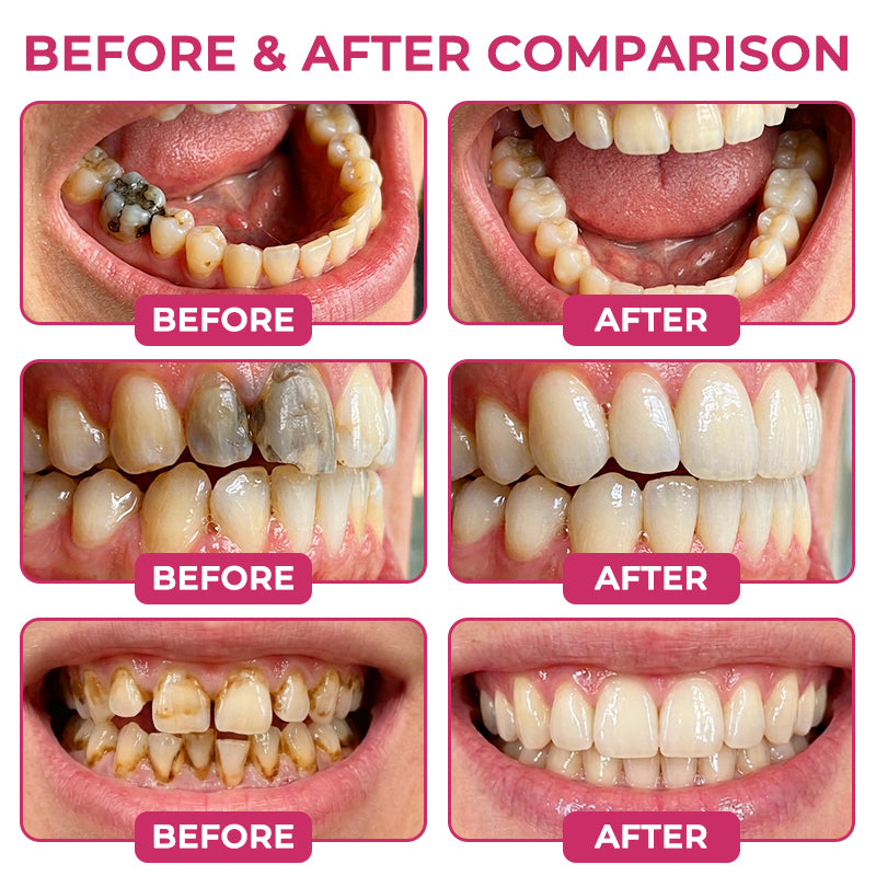 🦷 LXNDS DenPerm Cavity-Repair Natural Enamel Filling Gel
